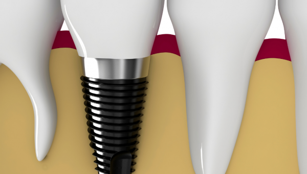 أسعار زراعة الأسنان في مسقط